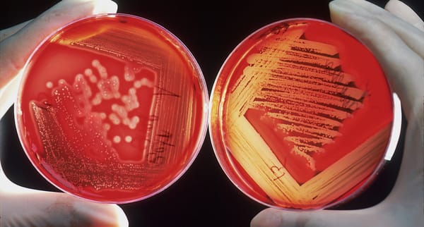 Opportunistic Infections: Pneumocystis jirovecii Pneumonia (PJP)